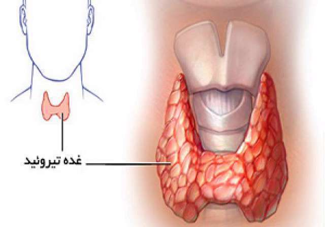 غده تیروئید، هیپرتیروئیدیسم، پرکاری تیروئید، هایپر تیروئیدیسم ، غده تیروئید، هیپرتیروئیدیسم، پرکاری تیروئید، هایپر تیروئیدیسم ،