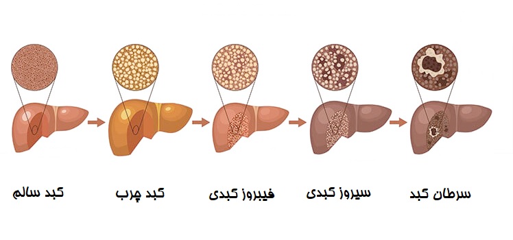 بیماری کبدی