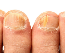زردی ناخن‌ها، علت‌ها و درمان